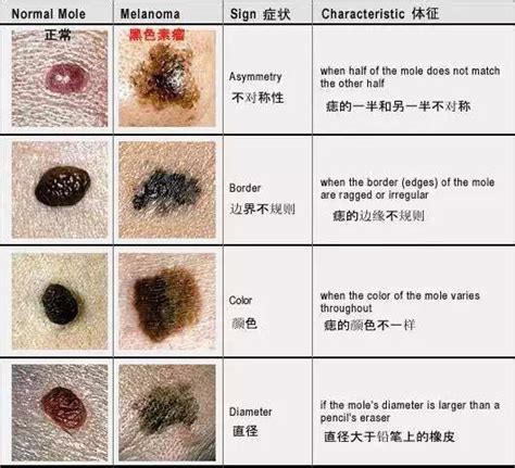 屌上有痣|龟头上有个黑痣该如何治疗呢？